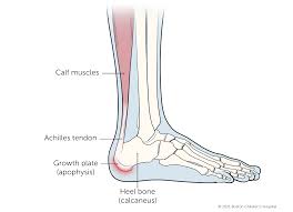 Image result for Calcaneal Apophysitis