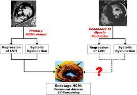 Is Regression Of Left Ventricular Hypertrophy Really A Good Thing For Patients With Hypertrophic Cardiomyopathy The Emerging Mavacamten Story American Journal Of Cardiology