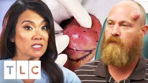 Ahead of the season 3 premiere of dr. Dr Lee Squeezes An 18 Year Old Cyst Dr Pimple Popper Youtube
