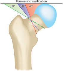 A transverse temporal bone fracture is shown in the image below. Jaypeedigital Ebook Reader