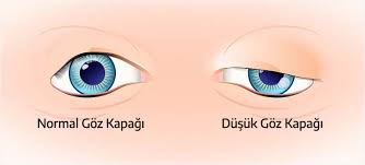 goz kapagi dusuklugu ameliyati fiyatlari prof dr altug cetinkaya
