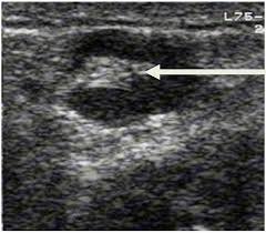 Two in three cases of thyroid cancer occur in people under age 55, and 75%. Local Metastasis In Head And Neck Cancer An Overview Intechopen