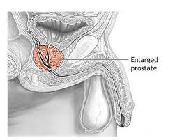 Adenom de prostata poate prezenta manifestari clinice evidente, specifice sau poate evolua multa vreme asimtomatic. Poze Medicale Prostata Si Problemele Ei