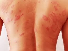 Image result for sweat rash on back