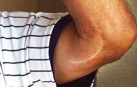 Tommy john surgery is a procedure used to repair the ulnar collateral ligament located on the inside or medial side of the elbow. The Truth About Tommy John Surgery New England Baseball Journal