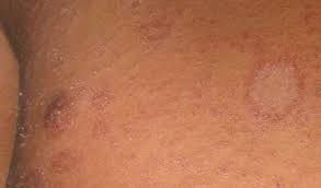Characterized by scaly, pink, inflamed skin, the condition can last from 1 to 3 months and usually leaves no lasting marks. Roschenflechte Pityriasis Rosea Symptome Und Therapie