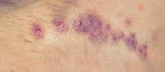 Image result for scabies human bites