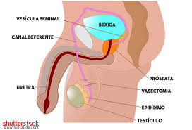 En profamilia puedes acceder a un procedimiento rápido, seguro y. Vasectomia Como E Feita Doi E Reversivel Md Saude