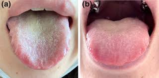 Image result for yellow tongue infection