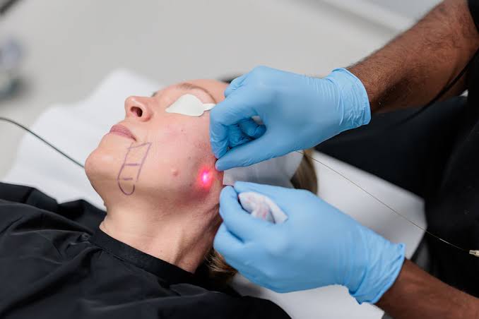 Endolift vs Ultherapy | The Differences Explored