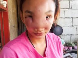 Girl, 17, blinded by mystery illness sparked from squeezing 'harmless' nose  spot