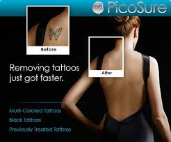 Tattoo Removal Boston Ma Picosure Laser Before And After Photos Courtesy Cynosure Http Www Tat Tattoo Removal Cost Picosure Tattoo Removal Tattoo Removal