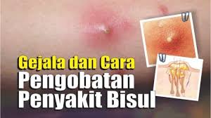 Video Apa Itu Bisul Gejala Dan Cara Pengobatan Penyakit Bisul Tribun Lampung