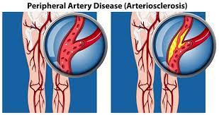 Peripheral Arterial Disease Foot Health Clinic Samford Village Qld