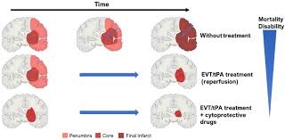 Image result for Stroke Pathophysiology