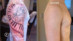At your first visit, we will develop a treatment plan that best suits you and your tattoo needs, answer all of your questions, and work with you to decide if removal is right for you. Picosure Tattoo Removal Pulse Light Clinic London