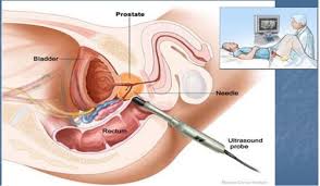 Urinary obstruction occurs in advanced disease. Prostate Cancer Flashcards Quizlet