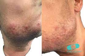 This leaves your hair shinier, healthier and more volumized. A Dermatologist S Tips For Ingrown Hairs Skin Care And Shaving