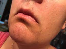 Qqcute electrolysis facial hair remover for women, painless facial hair removal for cheek, lips, chin and peach fuzz, battery powered. Pcos Facial Hair Electrolysis How I Deal With It Hirsutism My Pcos Kitchen