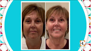 FaceTite BodyTite, by Dr Forrest Roth, West Ave Plastic Surgery, Houston,  Texas