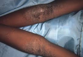 Scabs will heal on their own, but they may take more than a few weeks to completely do so. Eczema On Black Skin Pictures Symptoms And Treatment