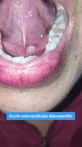 Image result for Sialoadenitis