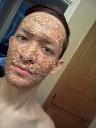 How to get rid of acne in a week! How To Get Clear Skin For Men Arxiusarquitectura