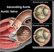 Pin By Jan Bullock On Heart In 2020 Bicuspid Aortic Valve Heart Valves Aortic Valve Replacement