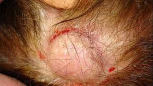 Here is all you need to know about ingrown draining an ingrown hair with a lump can be very painful. Ingrown Hair Cyst Identification Removal And More