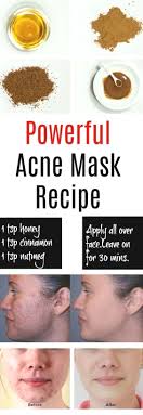 Home Remedies For Pimples And Blackheads For Oily Skin Best Home Remedy For Acne Overnight Homema Natural Acne Mask Home Remedies For Pimples Natural Acne