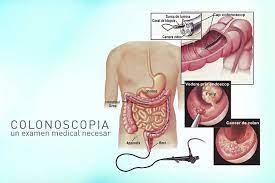 I polipi sono una delle condizioni più comuni che colpiscono il colon e il retto, si verificano in una percentuale che varia dal 15 al 20 % della popolazione adulta. Colonoscopie Un Examen Medical Necesar Proctoline