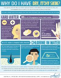 If You Get Dry Itchy Skin After You Shower Wash Your Hands Or Wash Dishes Or If Your Hair Gets Dry Washing Dishes Water Softener Whole House Water Filter
