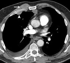 Pleural effusion is a disease that affects the space between layers of tissue in the lungs, known as the pleura. Multimodality Imaging For Characterization Classification And Staging Of Malignant Pleural Mesothelioma Radiographics