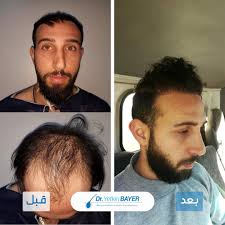 قبل وبعد زراعة الشعر Incoming Call Screenshot