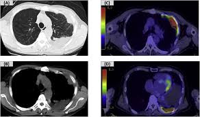 14.01.2020 · find mesothelioma kidney cancer information. A Case Of Primary Lung Squamous Cell Carcinoma Mimicking Malignant Mesothelioma Producing Granulocyte Colony Stimulating Factor With Chemotherapy Cisplatin And Gemcitabine Associated Thrombotic Thrombocytopenic Purpura Ttp An Autopsy Case Report