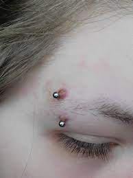 Irritated Infected Eyebrow Piercing I Ve Had It Since Last November 4 Months And It S Been Nothing But Problems It Started Off With Small Bumps Which Were Solved With A Change To Shorter Jewelry But