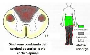La sclerosi multipla, conosciuta anche come sclerosi a placche, è una malattia cronica demielinizzante di tipo autoimmune, che colpisce cervello e midollo spinale: Le Sindromi Midollari