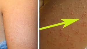 Tienes Estos Granitos En Los Brazos Asi Puedes Eliminarlos Como Eliminar Granitos Remedios Para El Acne Manchas En Los Brazos