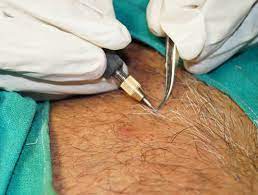 All of the other devices are ipl hair removal devices. Permanent Hair Removal Electrolysis In Preet Vihar Delhi Reyuva Hair Transplant Center Id 8402515173