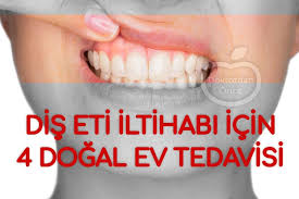 Dis Eti Iltihabi Icin Evde Uygulayabileceginiz 4 Tedavi Doktordan Once Health Healthy Lifestyle Teeth