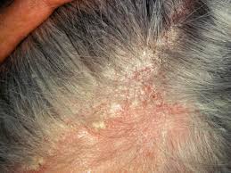Image result for dry scabs on the head in children
