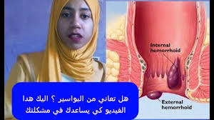ماهي أعراض البواسير وماهو علاج البواسير الداخلية والخارجية youtube