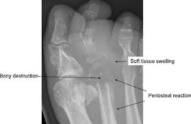 Image result for Osteomyelitis XRay