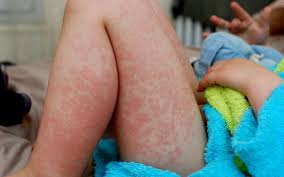 Ringelroteln Symptome Bilder Behandlung Onmeda De