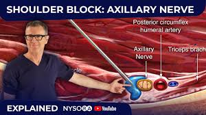 Image result for Axillary Nerve Block