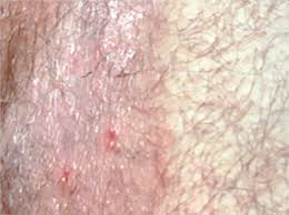 Image result for sore skin in the groin area
