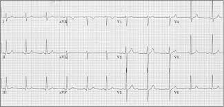 For instance note in the ekg Ecg Learning Center An Introduction To Clinical Electrocardiography