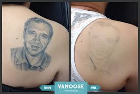 Laser Tattoo Removal After 2 Sessions Make Tattoo Removal Cream At Home