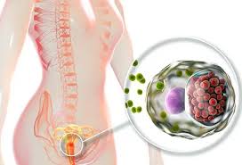 Image result for chlamydia symptoms