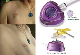 Pin On Vascular Access